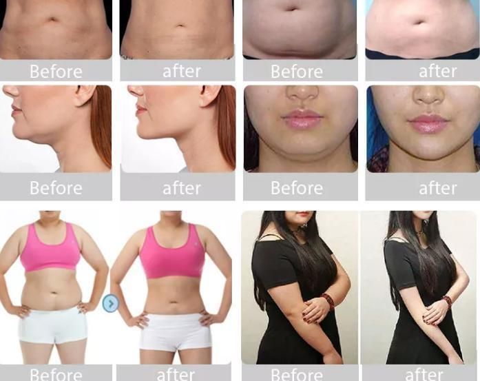 Sunrise Body Shaping Fat Freezing Cryolipolysis RF Lifting Cavitation Lipo Laser Slimming Beauty Cryo Equipment