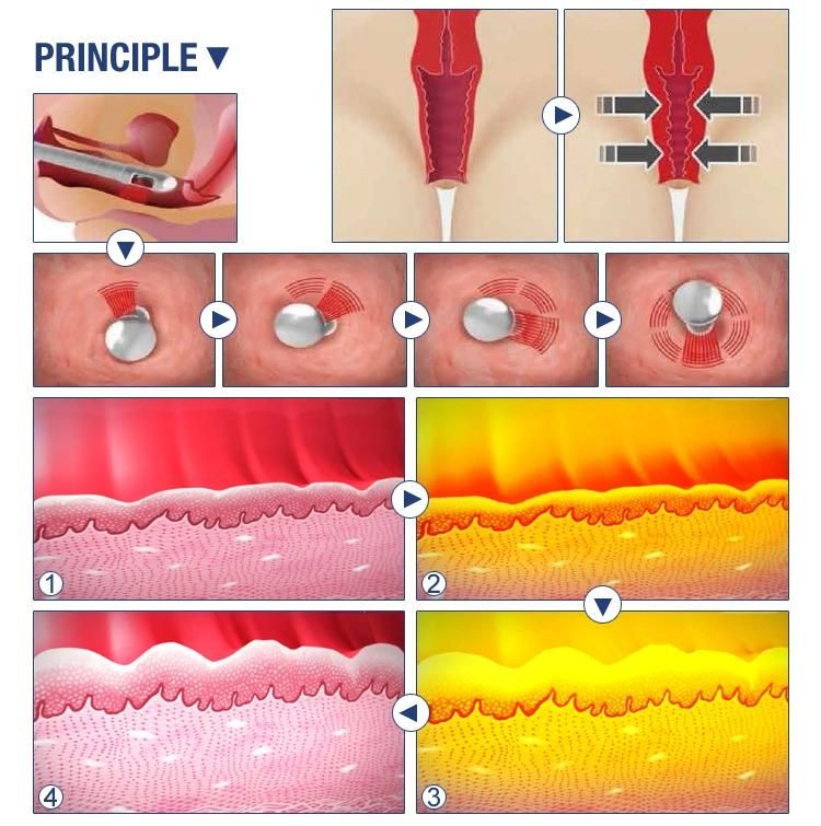 CO2 Fractional Laser Beauty Machine Vaginal Tightening Rejuvenation Laser Equipment