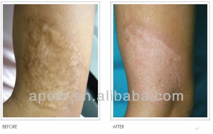 Acne Blemish Treatment 2940nm Fiber Laser Equipment Er YAG Laser for Dark Skin Patches Treatment