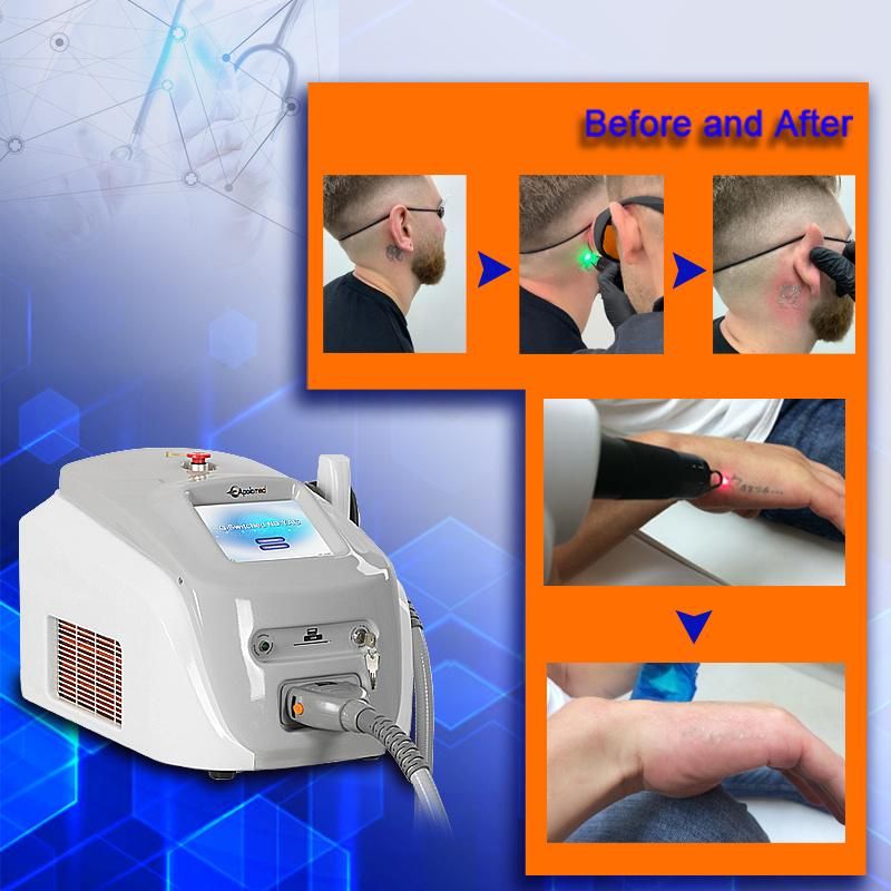 Laser Skin Treatment Equipment CE Medical Approval Tattoo Studio Use Portable ND YAG Laser Tattoo Removal