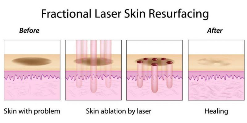 CO2 Fractional Laser Skin Resurface /Scar Remove Beauty Equipment for Sale