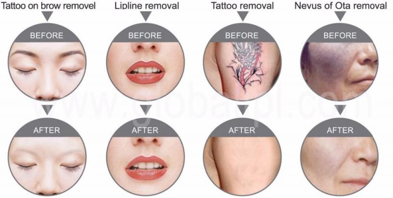 Coffee Spot Colorful Tattoo Removal Berauty Salon Machine