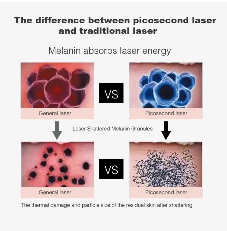 Guangzhou Factory Picosecond Pulsed Laser Tattoo Removal Specialist