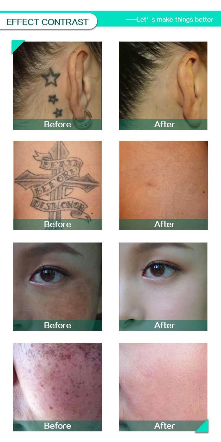 Freckle Chloasma Hollywood Peeling Pico Second Qswitch ND YAG Laser Tattoo Removal Medical Beauty Equipment