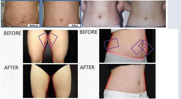 Professional Cryolipolysis Body Shaping with Cooling System Beauty Salon and Clinic Machine