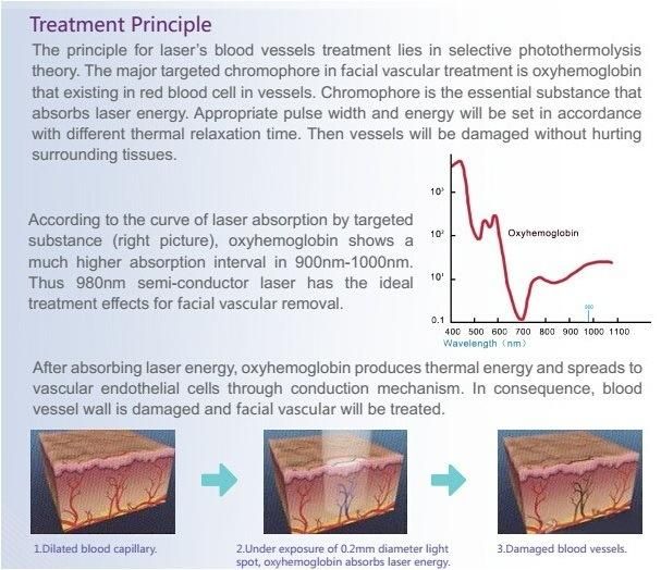 Vascular Removal Spider Vein Removal 980nm Medical Diode Laser