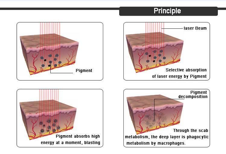 Professional Medical 1064nm Laser Tattoo Removal