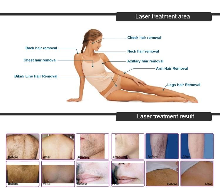 Best Laser Diode Price/Painless Permanent Laser Hair Removal