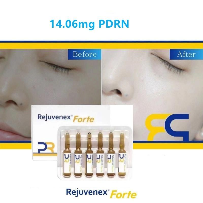 2022 Mesotheraphy Rejuran Pdrn Salmon Rejuvenex Forte Skin Rejuvenation Baby Face Skin Dysport Profhilo Azzalure H-DNA Curenex Hyalurononate Sodium Gel