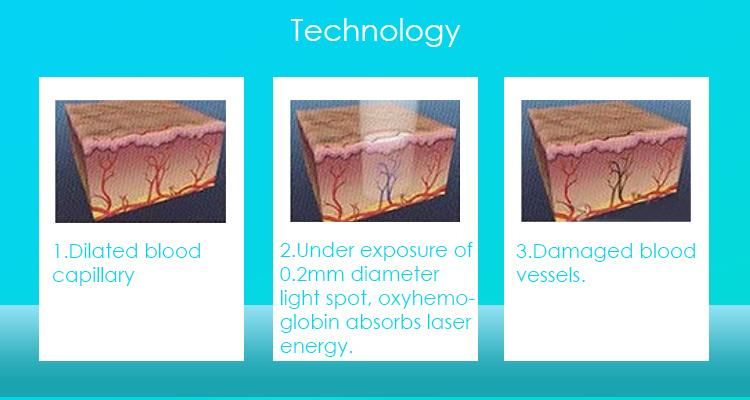 Ce Approved Advanced 980nm Diode Laser for Blood Vessels Removal