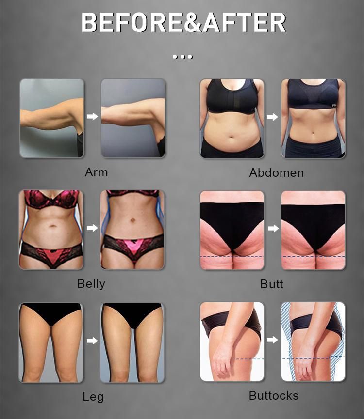 Body Shaping Sculpting Lose Fat Build Muscle Cellulite