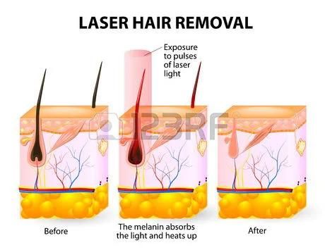 3 Wavelengths Hair Removal Diode Laser