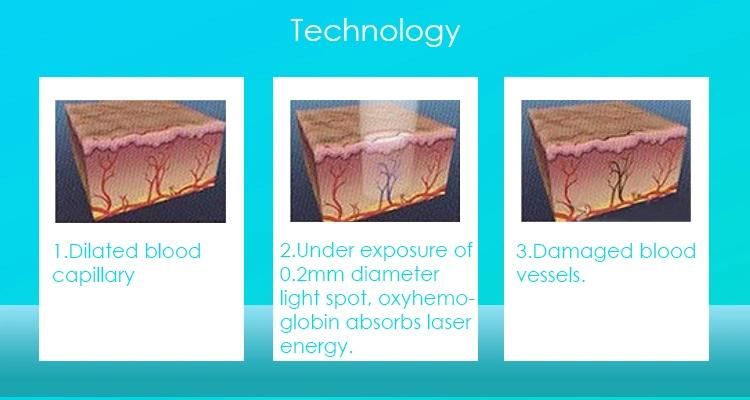 Age Spots and Pigments Lesion 980nm Diode Laser Vascular Removal