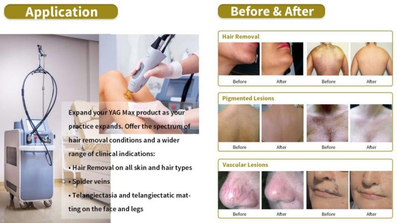 Sinco Effective and Permanent Hair Removal with 755nm and 1064nm on All Skin and All Types Vascular Removal