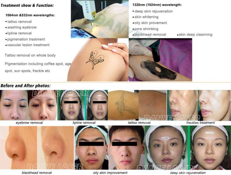 Danye ND YAG Laser Tattoo Removal Carbon Peeling YAG Laser Machine