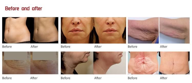 RF Skin Tightening Machine Face Lifting Face Lift Machine