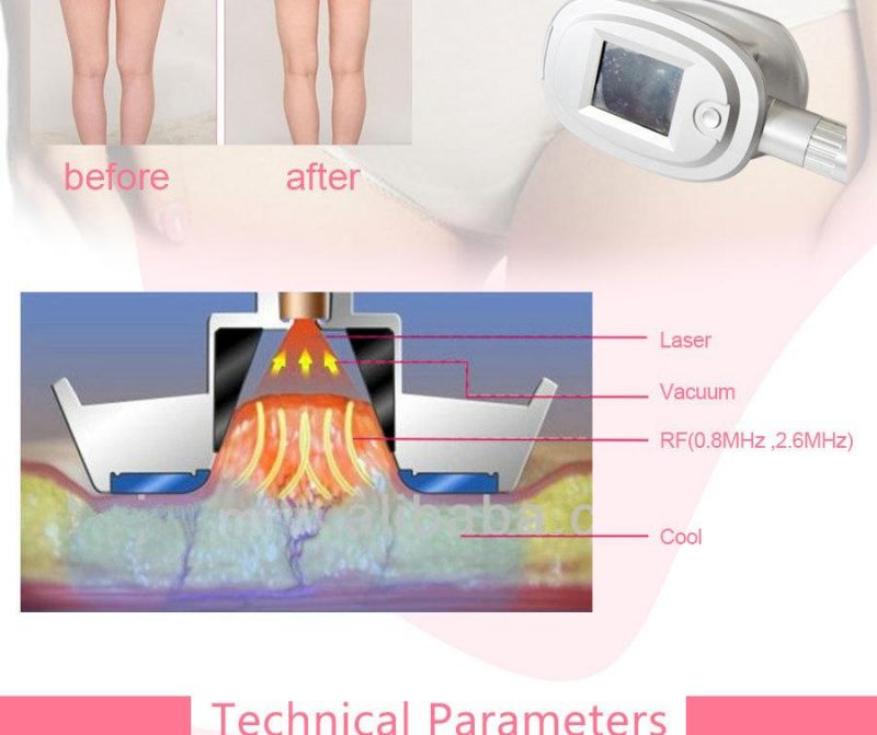 RF Vacuum Cryolipolysis Freeze Fat Slimming Machine