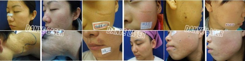 Medical Fractional Laser Light for Stretch Marks Removal Skin Resurfacing CO2 Equipment