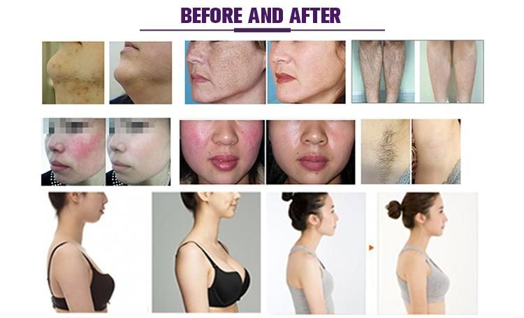 IPL+Diode Laser Beauty Equipment for No Pain Hair Removal