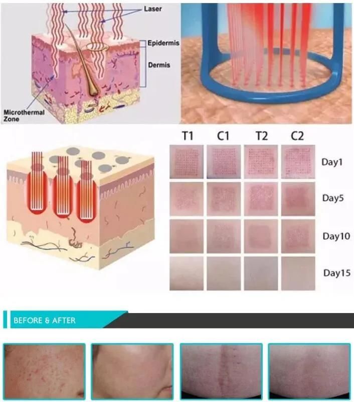 Fractional CO2 Laser Vaginal Rejuvenation& Skin Care Medical Beauty Equipment