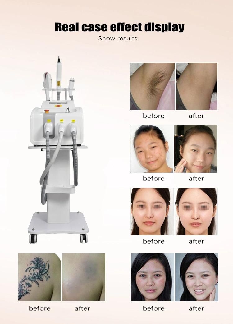 3 in 1 Elight IPL RF Laser Hair Removal Machine with Free Shipping