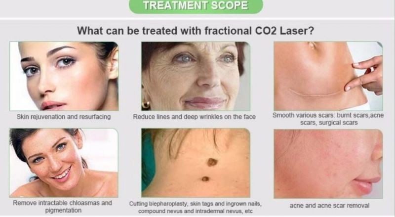 RF Drive Fractional CO2 Laser for Scar Removal Vaginal Rejuvenation