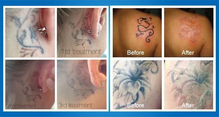 Med CE Approved ND YAG Laser for Tattoo Removal Permanent Make-up Removal