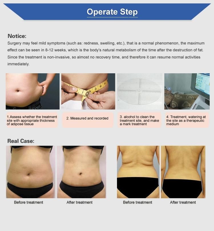 Good Effect Losing Weight and Tightening Skin Liposonix Slimming Machine