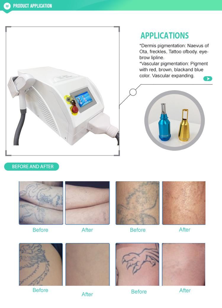 Sincoheren High Power Ndyag with 3 Tips Laser for Tattoo Removal Machine