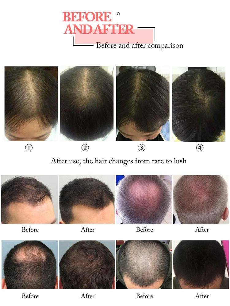 Effective Laser Anti Hair Loss Therapy Laser Hair Regrowth Machine