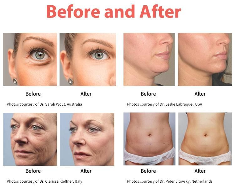 Anti Wrinkle Face Lift Skin Tightening Body Slimming Hifu Beauty Machine