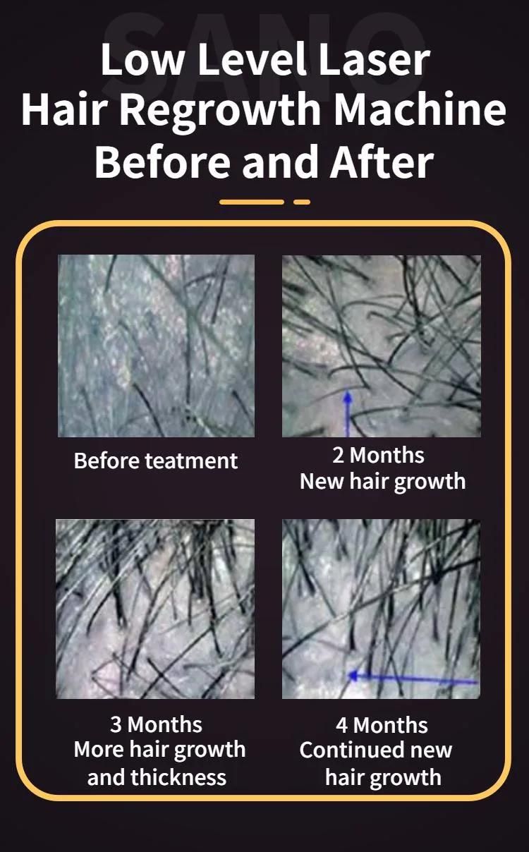 New Laser Hair Re-Growth Sysytem with Medical Ce (SH-650II)