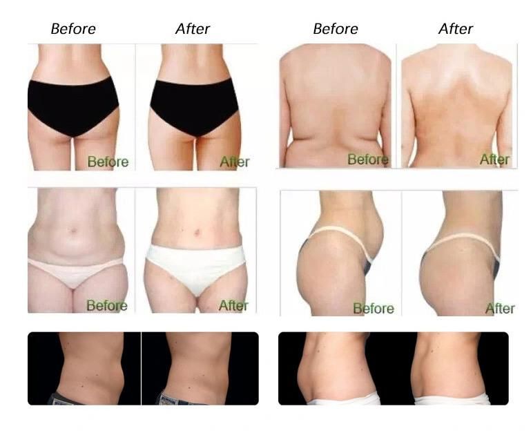 Comfort Weight Loss Cryolipolysis System for Beauty & Home Use