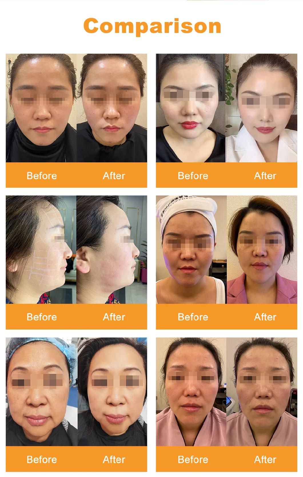 New Coming Mini Hifu Effects Facial Skin Care Machine, Face Lift RF LED Skin Re Juvenation Machine for Facial Lifting Tightening