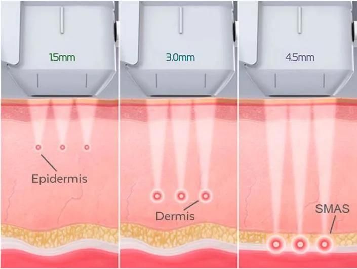 3 Treatment Handles Anti Aging 4D Hifu