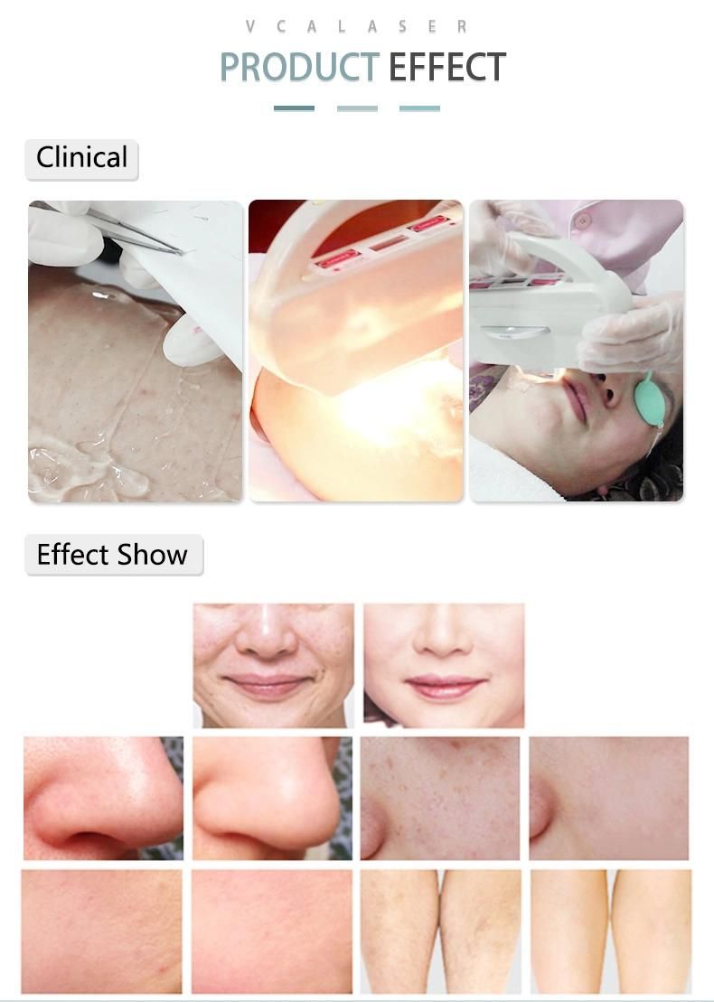 Beauty Salon Clinic Use Elight Shr Hair Removal