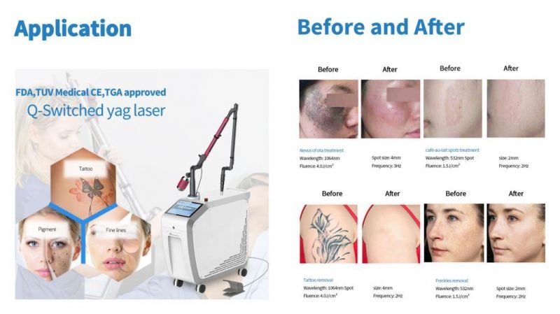 Consultant Be Hollywood Facial Carbon Peeling Q Switched ND YAG Laser with 1064nm and 532nm for Pigmentation Black Facial Doll Treatment