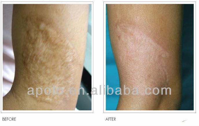 Advanced Air Cooling System Fractional 2940nm Fiber Laser Device Er YAG Laser for Stretch Marks Removal