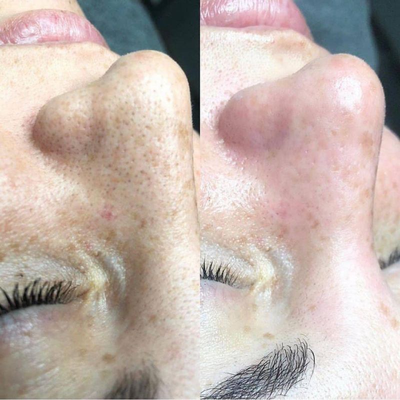 Multifunctional Hydra Dermabrasion Facial Skin Peeling Beauty Salon Machine