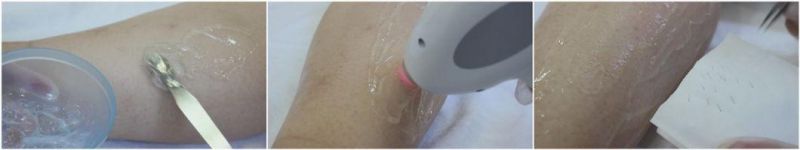 World First Fiber Coupled Diode Laser Removal Hair Machine