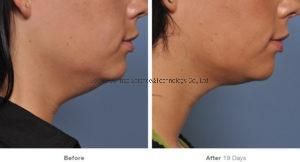 7D Hifu Wrinkle Removal Face Lift Machine 7D Korea Technology Face Lifting Ultra Hifu Wrinkle Removal Beauty Machine Hifu 7D