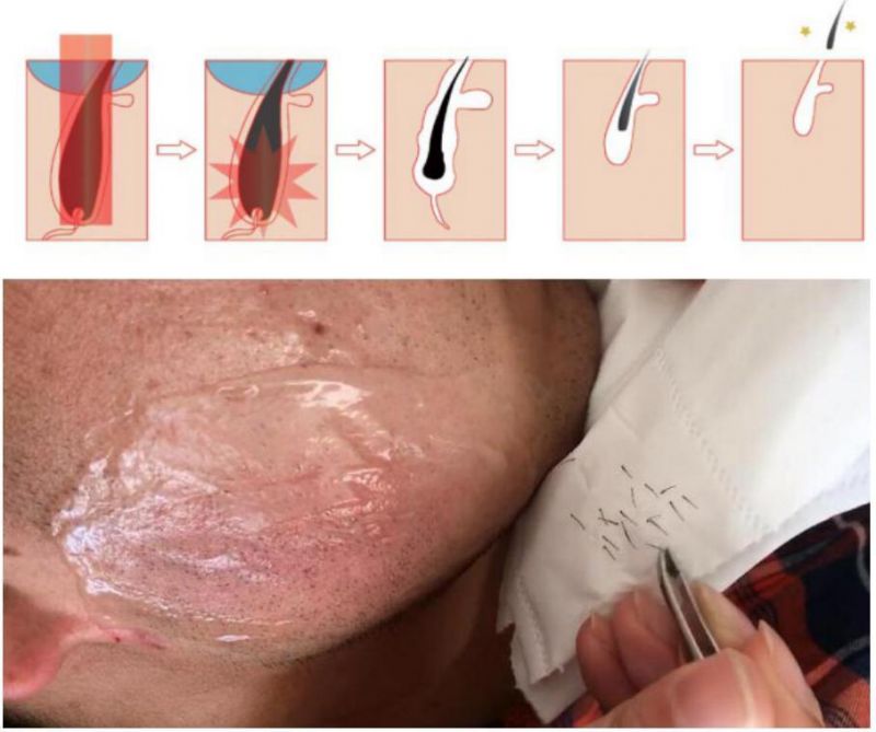 Painless  Permanent Hair  Removal /808  Fibercoupled Diode  Laser  /Laser  Hairline Removal