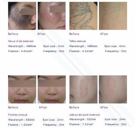 Consultant Be Best Selling Product 2022 in Europe Laser Tattoo Removal Q-Switched ND: YAG