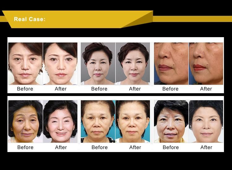 3D Hifu for Face, Chest, Body and Neck Wrinkle Removal