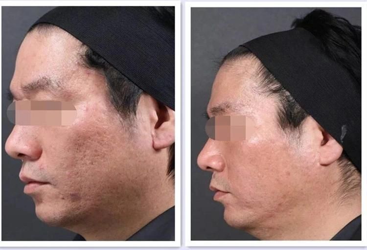 V-Face Lift Skin Rejuvenation Wrinkle Remover Vertical Design with Machine