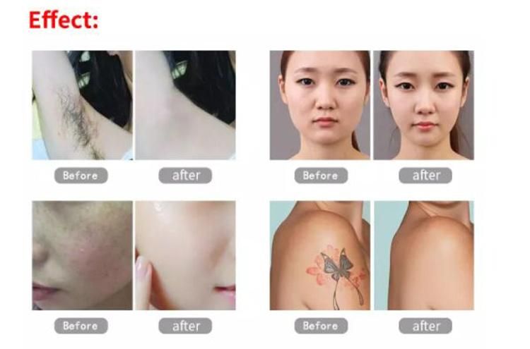 2019 New Style Laser Hair Removal Device Dpl Fast Hair Removal Machine + Picosecond Laser + RF Skin Tighten