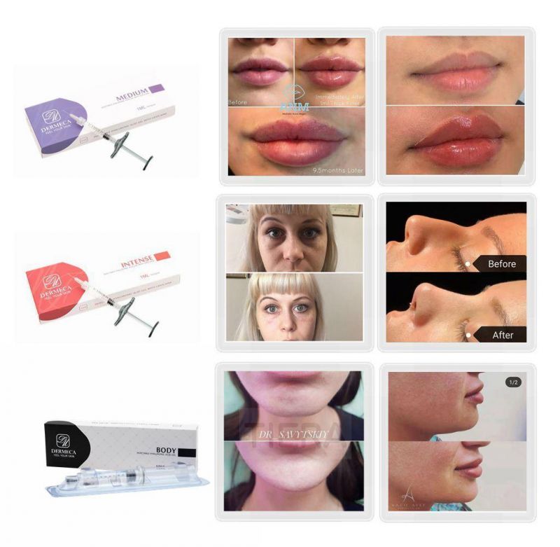 Factory Price Dermeca Beauty Injectable Filler Meso Serum Mesotherapy Gel Reshape Sexy Lip Cross-Linked Ha Dermal Filler 2ml Increase Lip Volume for Chin Filler