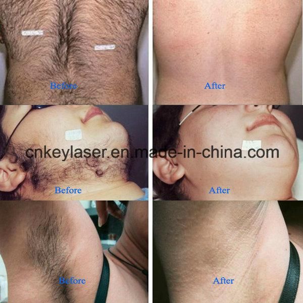 Latest Designed Best 808nm Diode Laser Hair Removal Machine