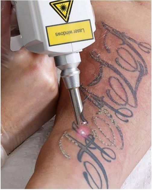 Tattoo Removal/Carbon Peeling Q-Switch ND: YAG Laser 1064nm