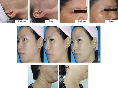 RF Super Magic Skin Tightening Facial & Body Beauty Machine